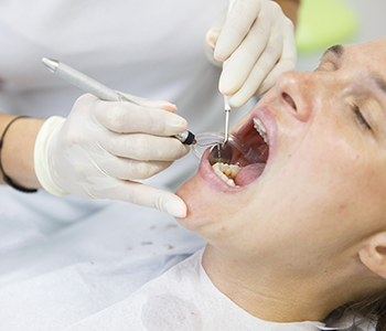 Tooth decay repaired with composite fillings by Parkdale dentist