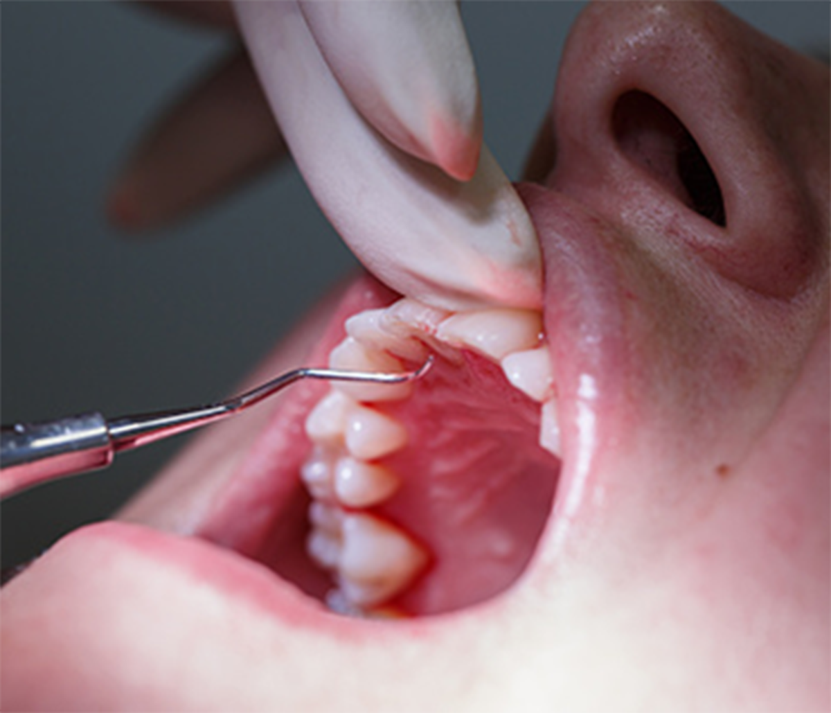 Dental Extractions By Dr. Karen Ho