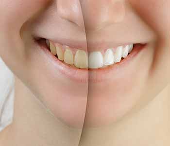 Without proper brushing and flossing, patients will accumulate plaque along the gum line,