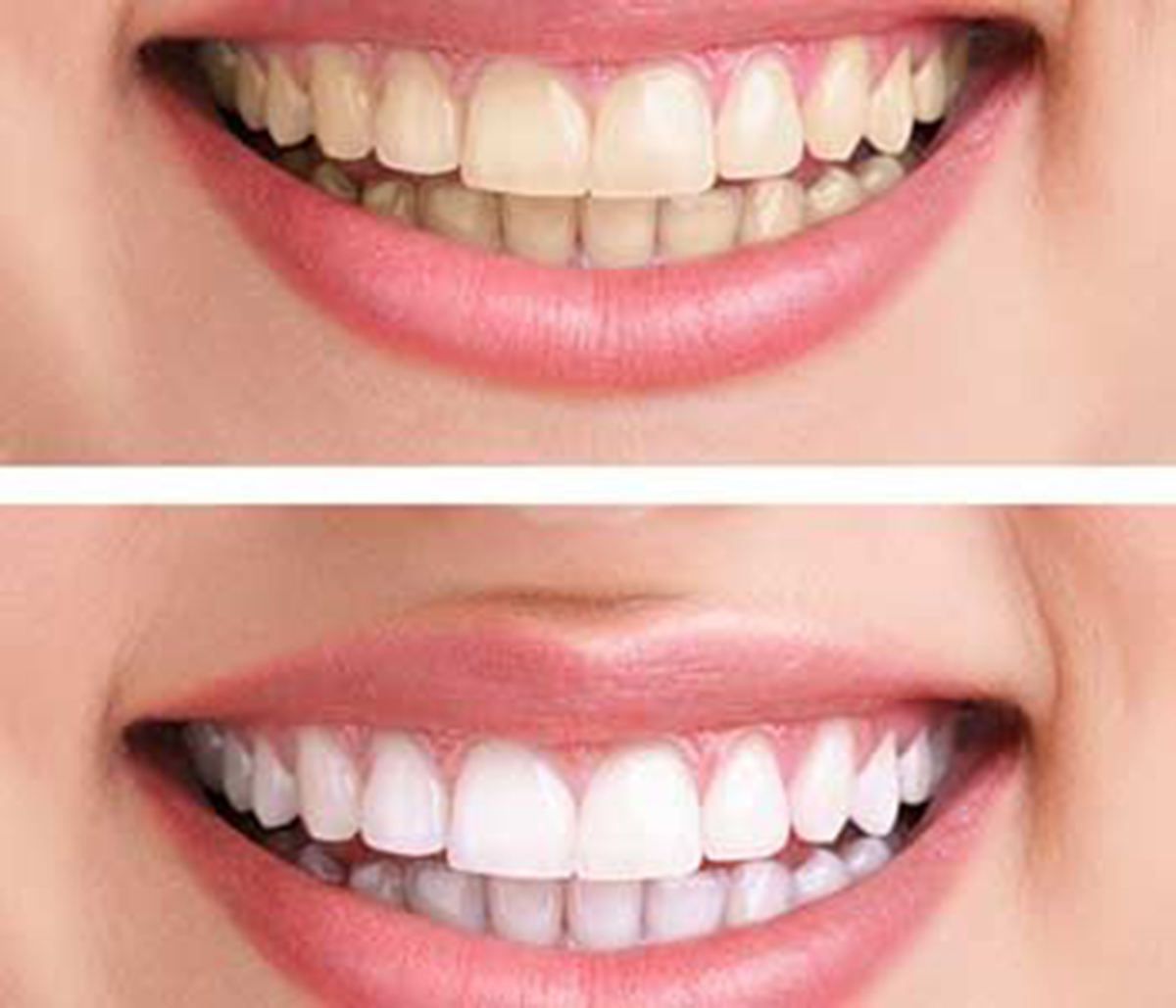 whitening - bleaching treatment ,before and after ,woman teeth and smile