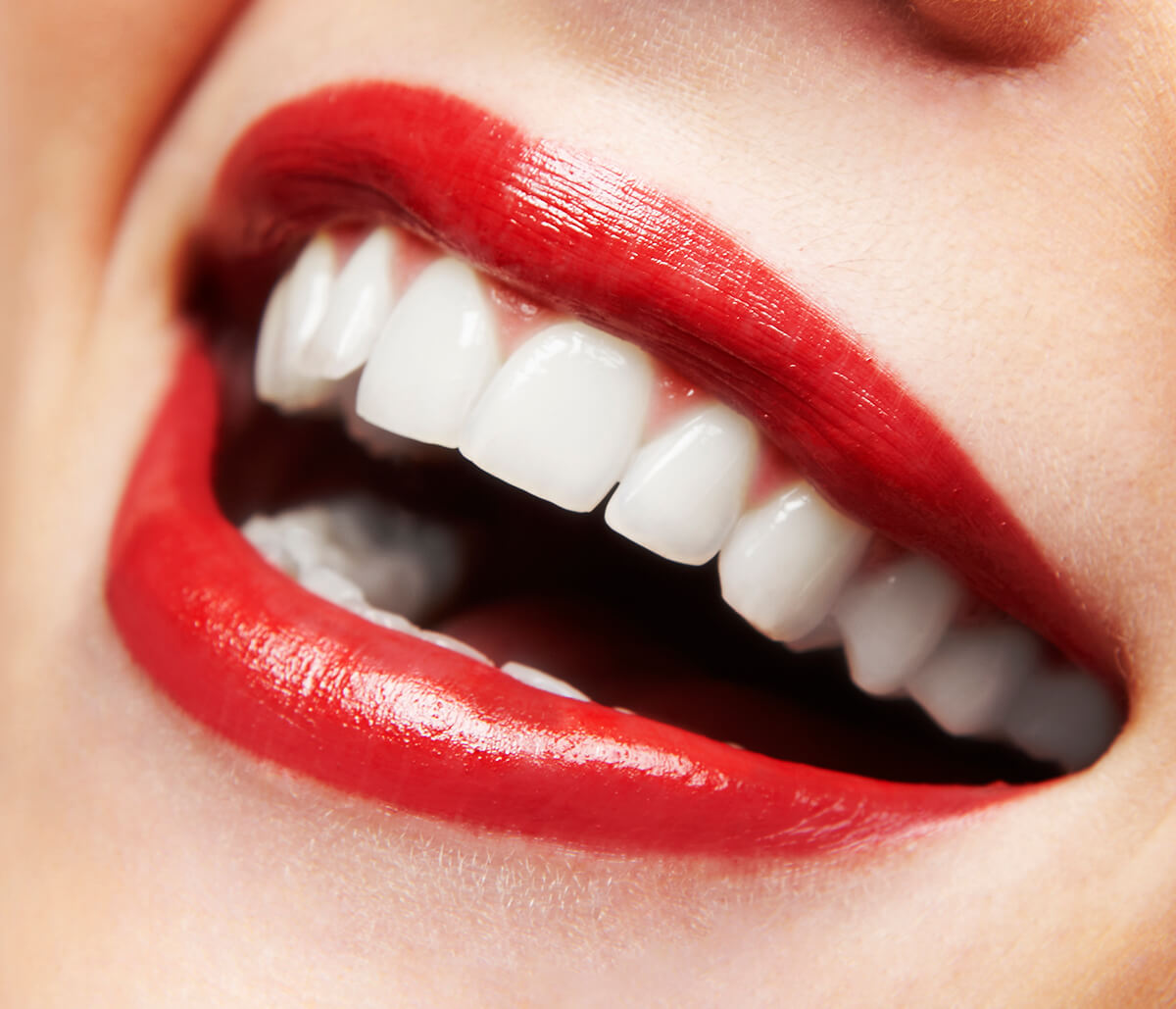 Teeth Whitening Dentistry in Hamilton Ontario Area