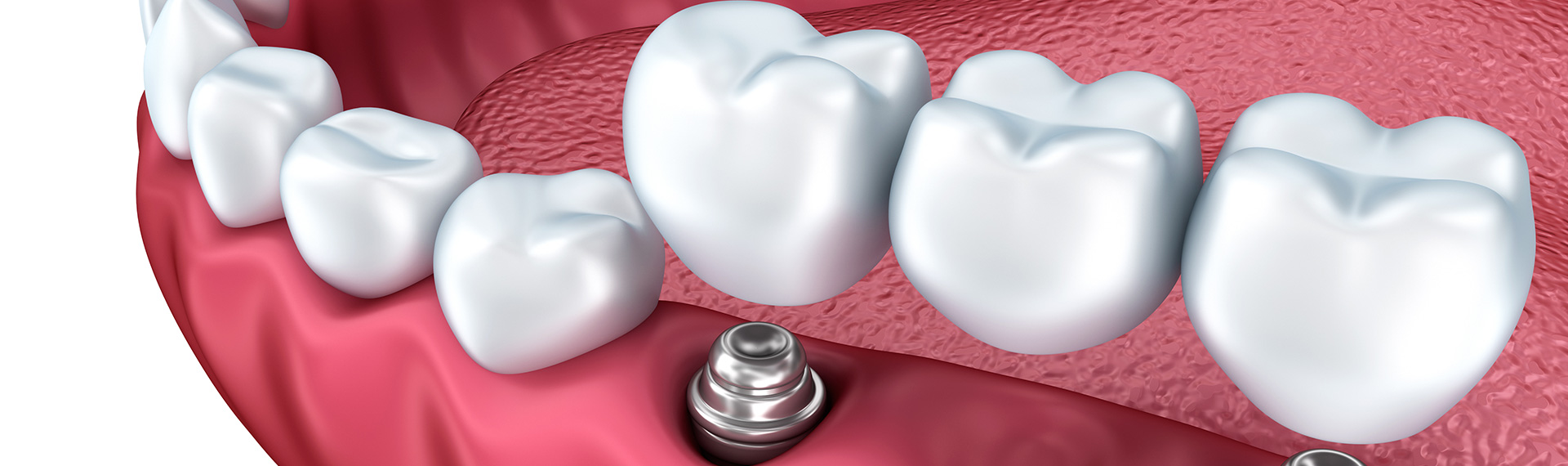 Learn More About Dental Crowns and Bridges Near Me In, Hamilton Ontario Area