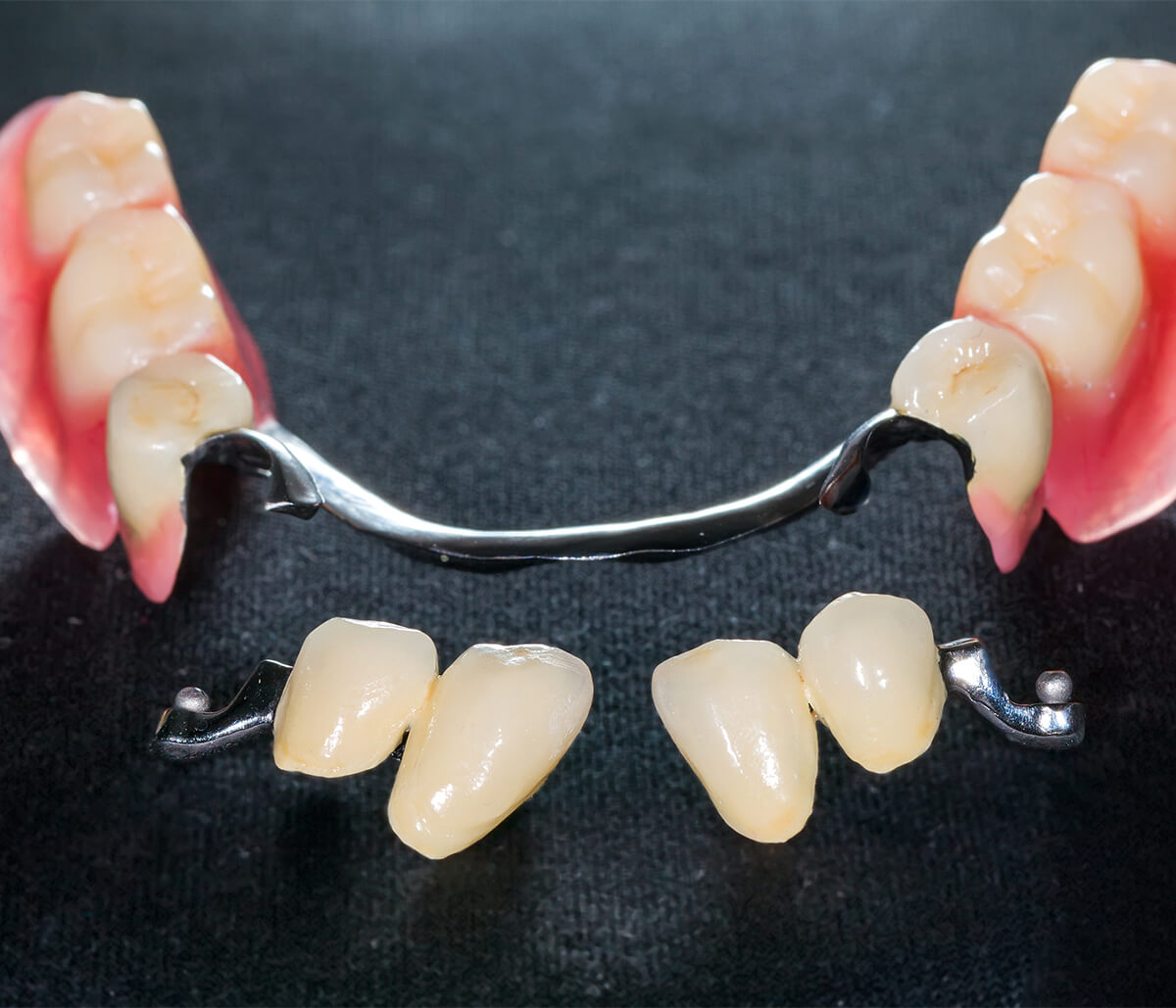 Partial Denture for One Tooth in Hamilton Ontario Area